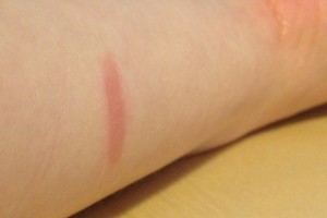 awkward picture of the burn on my arm